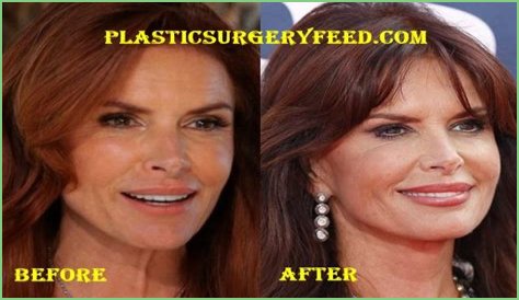 Roma Downey Plastic Surgery Before and After